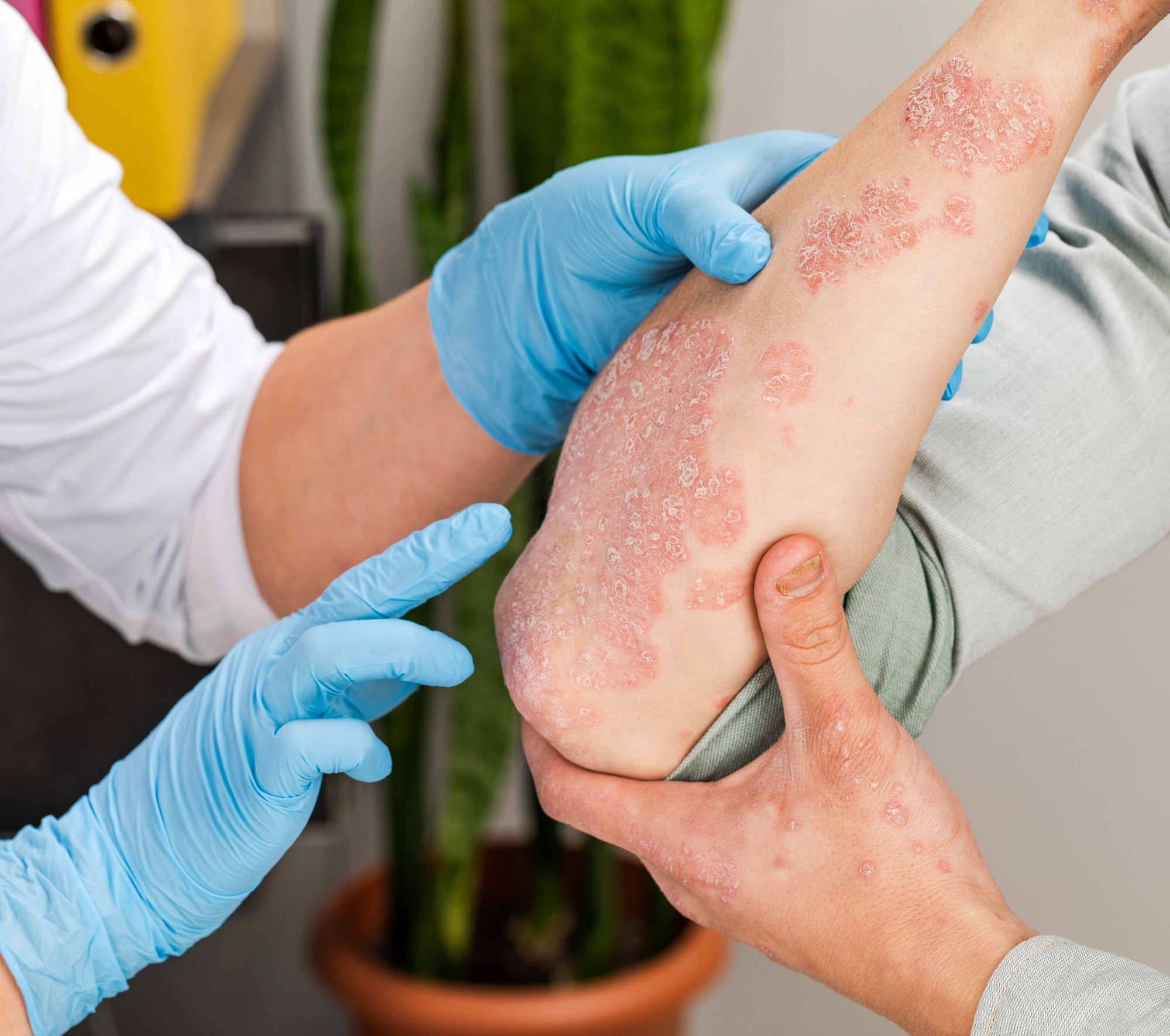 Dermatologe untersucht Patient mit Psoriasis_klein-1 Dermatologe untersucht Patient mit Psoriasis_klein-1